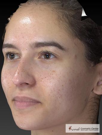 Venus Viva: Patient 3 - After Image 3