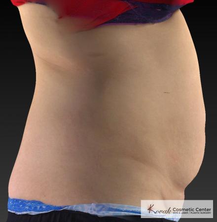 CoolSculpting®: Patient 26 - Before