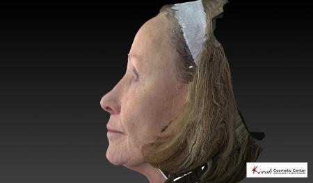 Halo™: Patient 2 - Before and After 5