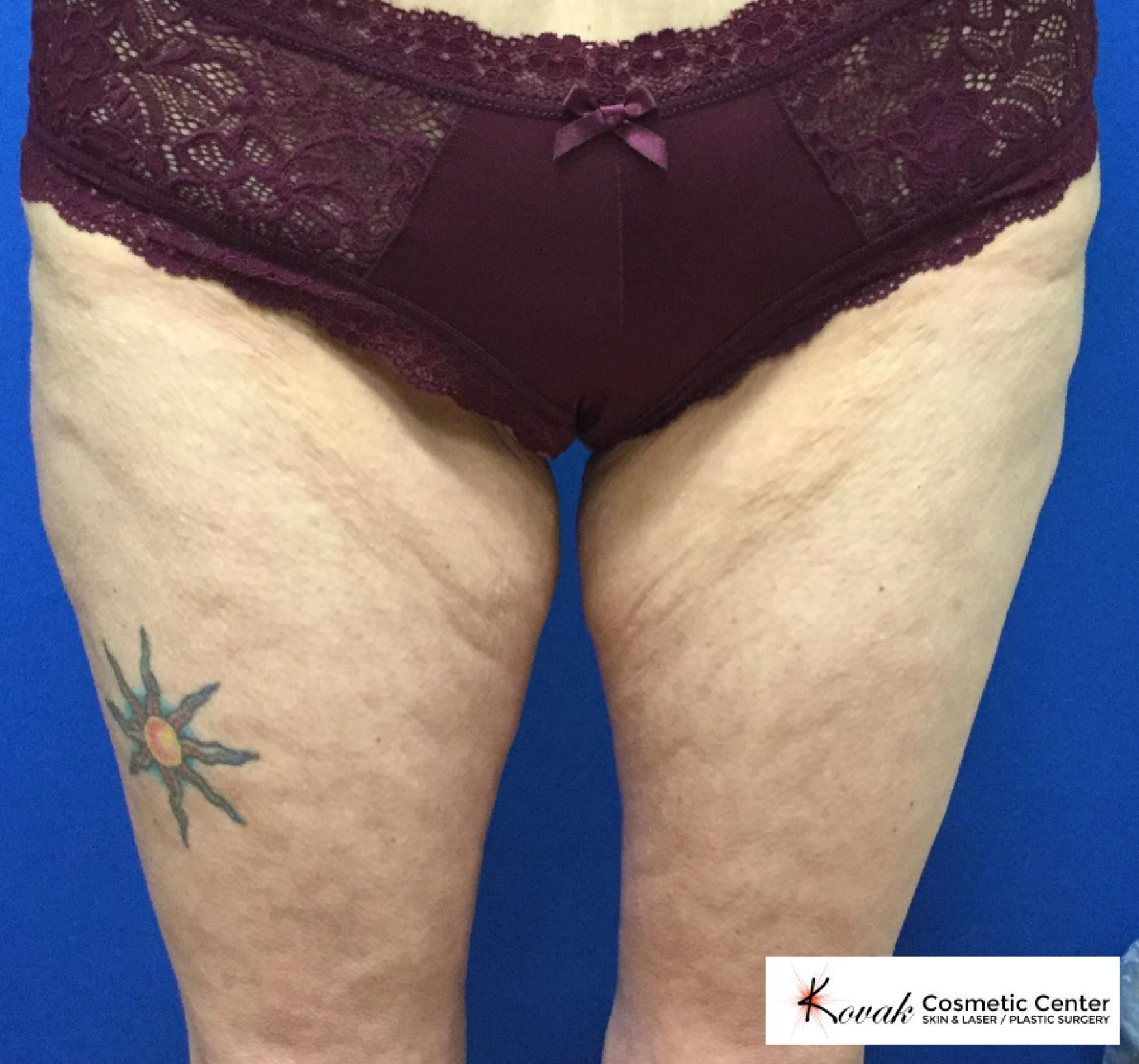EMSCULPT®: Patient 3 - Before 