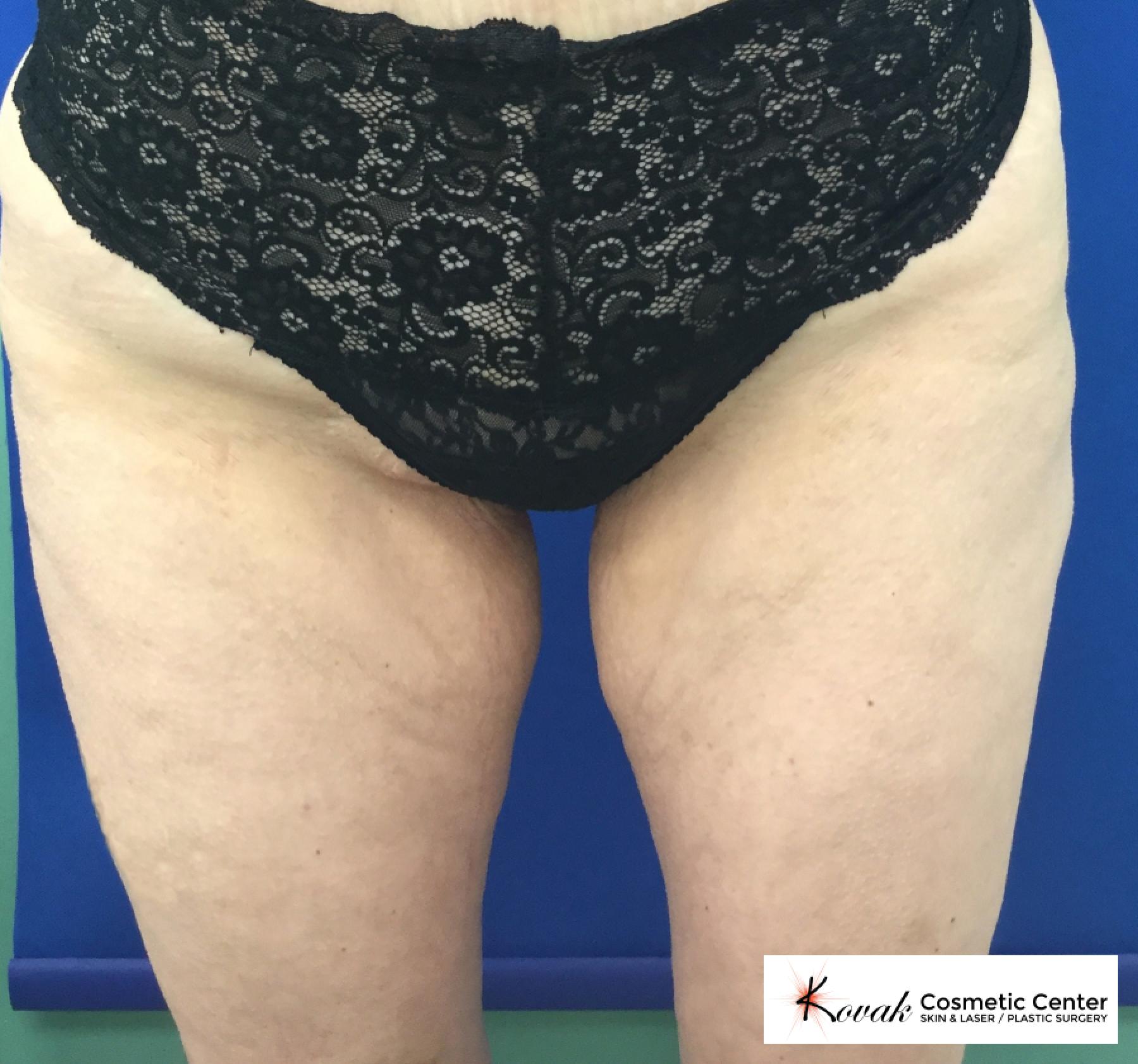 EMSCULPT®: Patient 3 - After  