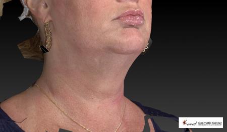 Kybella: Patient 1 - After Image 2