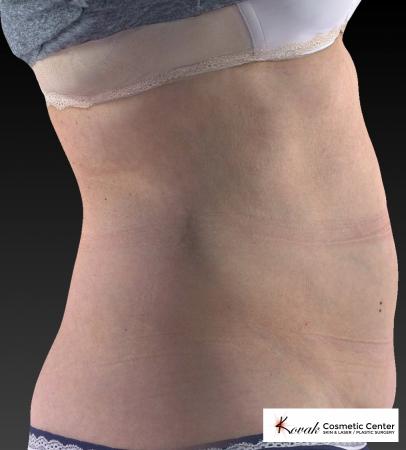 CoolSculpting®: Patient 12 - After 5