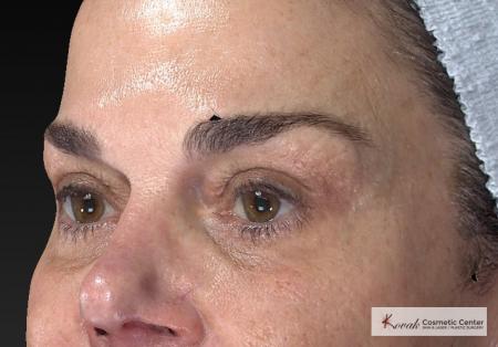 Laser Skin Resurfacing - Face: Patient 2 - After Image 3
