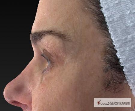 Laser Skin Resurfacing - Face: Patient 2 - After Image 2