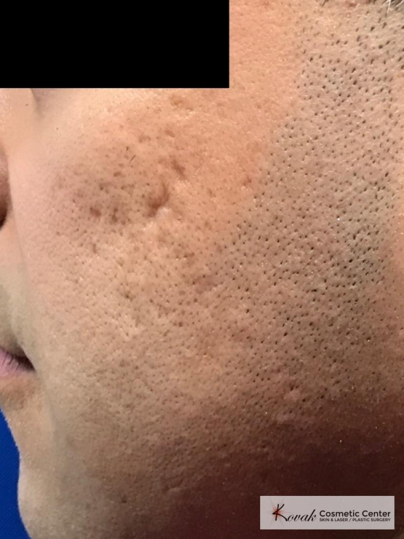 Acne Scars treated with Juvederm and Venus Viva on 35 year old male - Before 