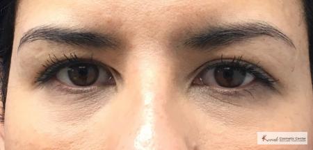 Restylane® Silk: Patient 14 - After 1