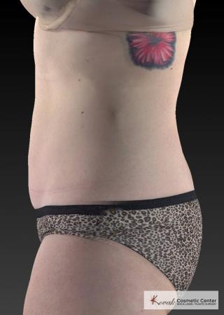 CoolSculpting®: Patient 25 - After