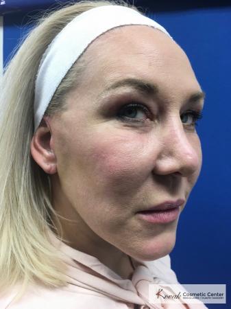 Neck Lift: Patient 3 - After 1