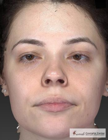Venus Viva: Patient 4 - After Image 4
