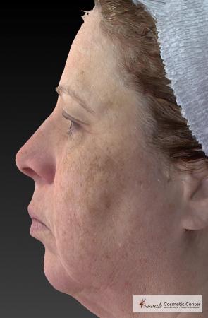 Tyte And Bryte – Face: Patient 3 - Before Image 2
