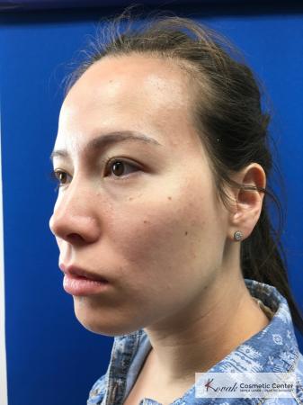 Restylane® Lyft: Patient 2 - Before 2