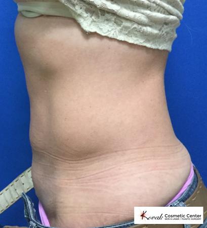 CoolSculpting®: Patient 2 - After 2