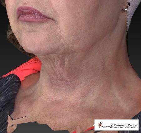 Kybella: Patient 2 - Before Image 3