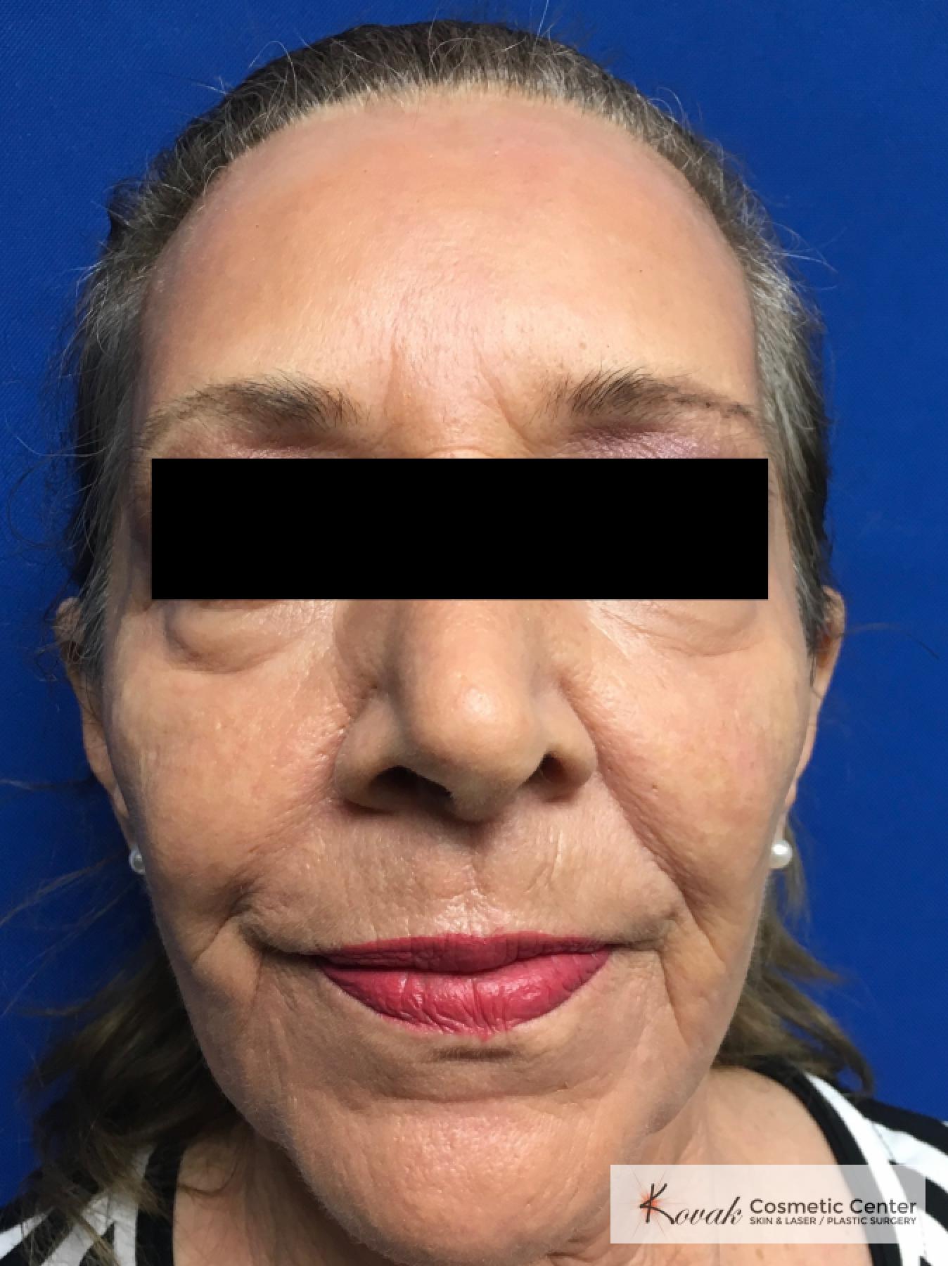 Full Face Laser Skin Resurfacing on a 70 year old woman - After  