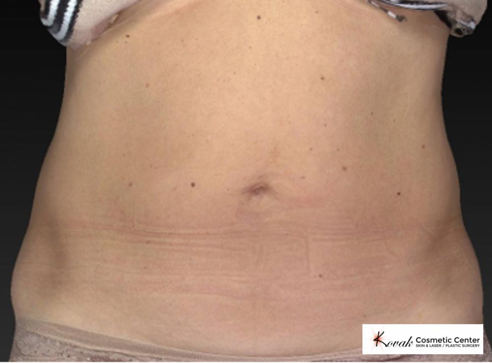 CoolSculpting®: Patient 10 - After  