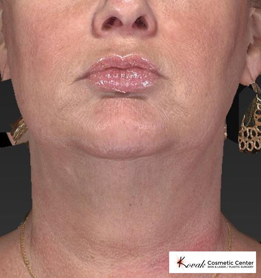 Kybella: Patient 1 - After  