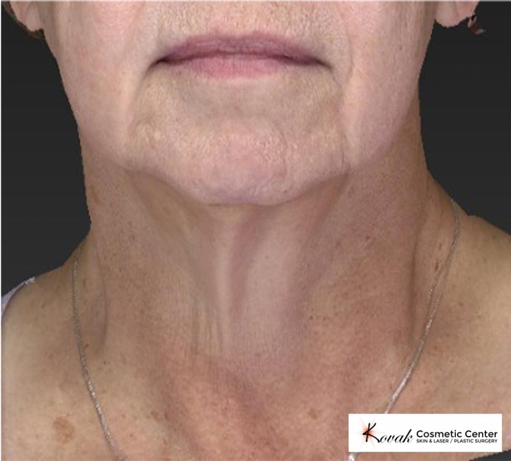 CoolSculpting®: Patient 6 - Before 