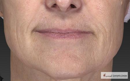 Injectables - Mouth: Patient 8 - After Image 1