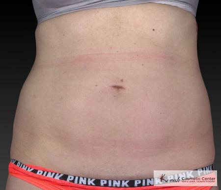 CoolSculpting®: Patient 27 - Before