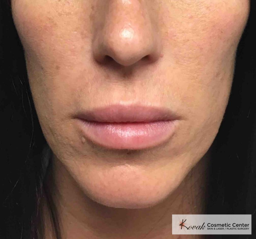 Injectables: Patient 7 - After  