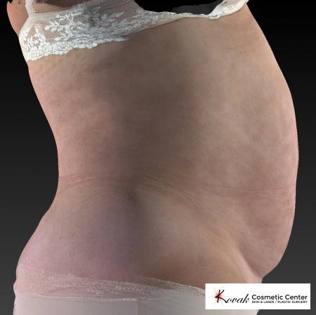 CoolSculpting®: Patient 11 - After 5