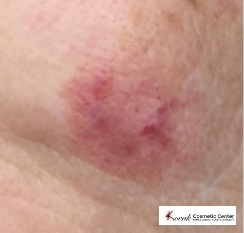Port Wine Stain: Patient 1 - After  