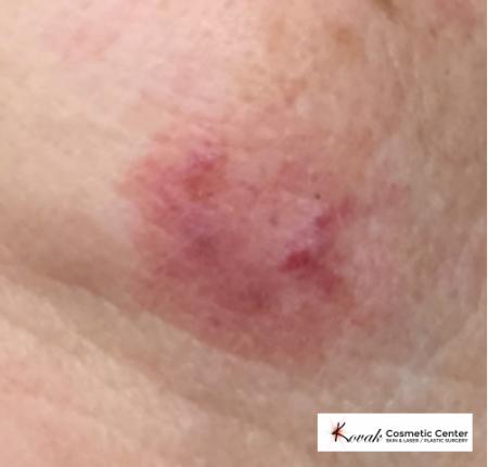 Port Wine Stain: Patient 1 - After 1