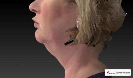 Kybella: Patient 1 - Before Image 4