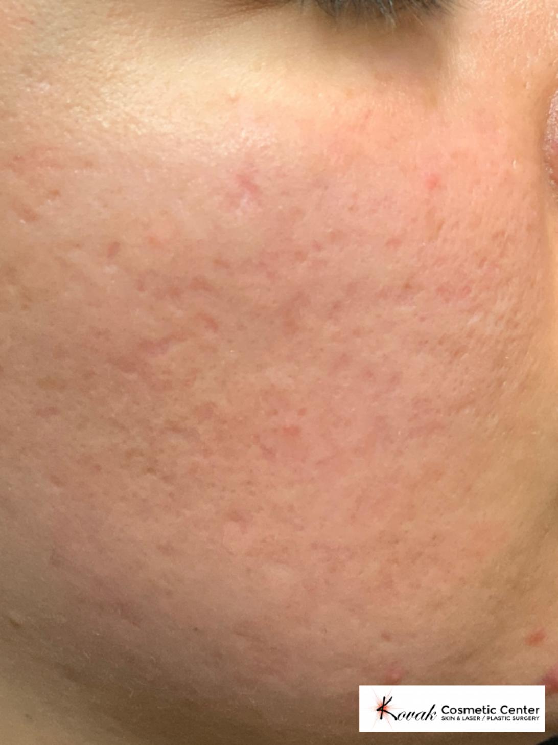 Acne Scars treated with Venus Viva on 30 year old female - After  
