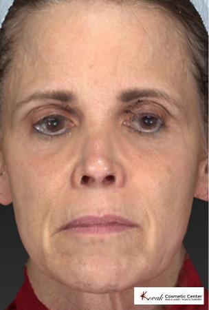 Silhouette Lift™: Patient 1 - Before and After Image 2