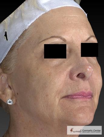 Sculptra®: Patient 5 - After 5