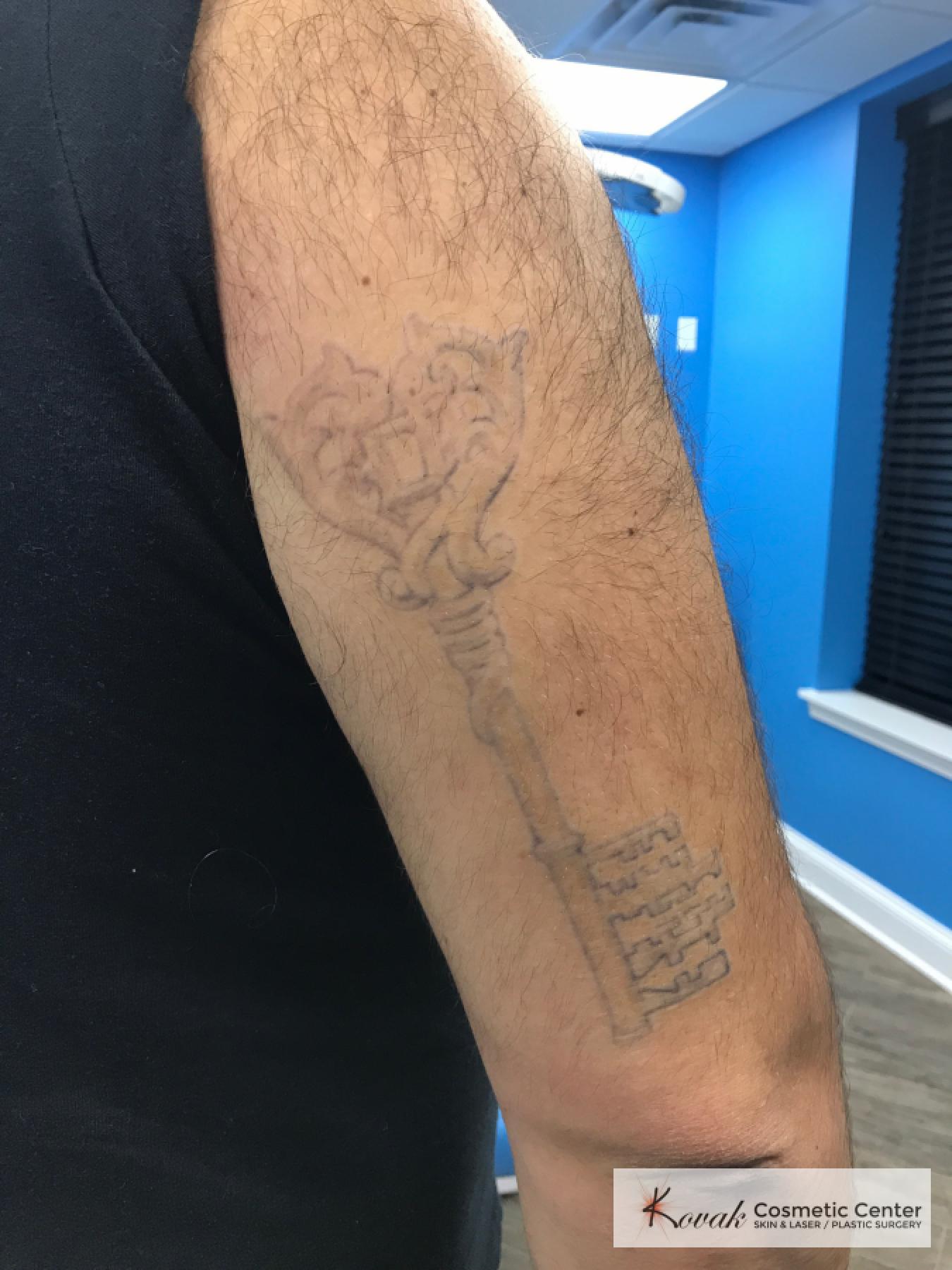 Tattoo Removal: Patient 4 - After  