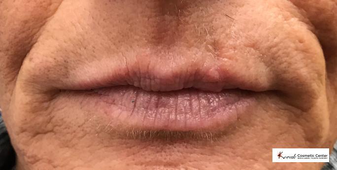 Restylane® Silk: Patient 3 - After  