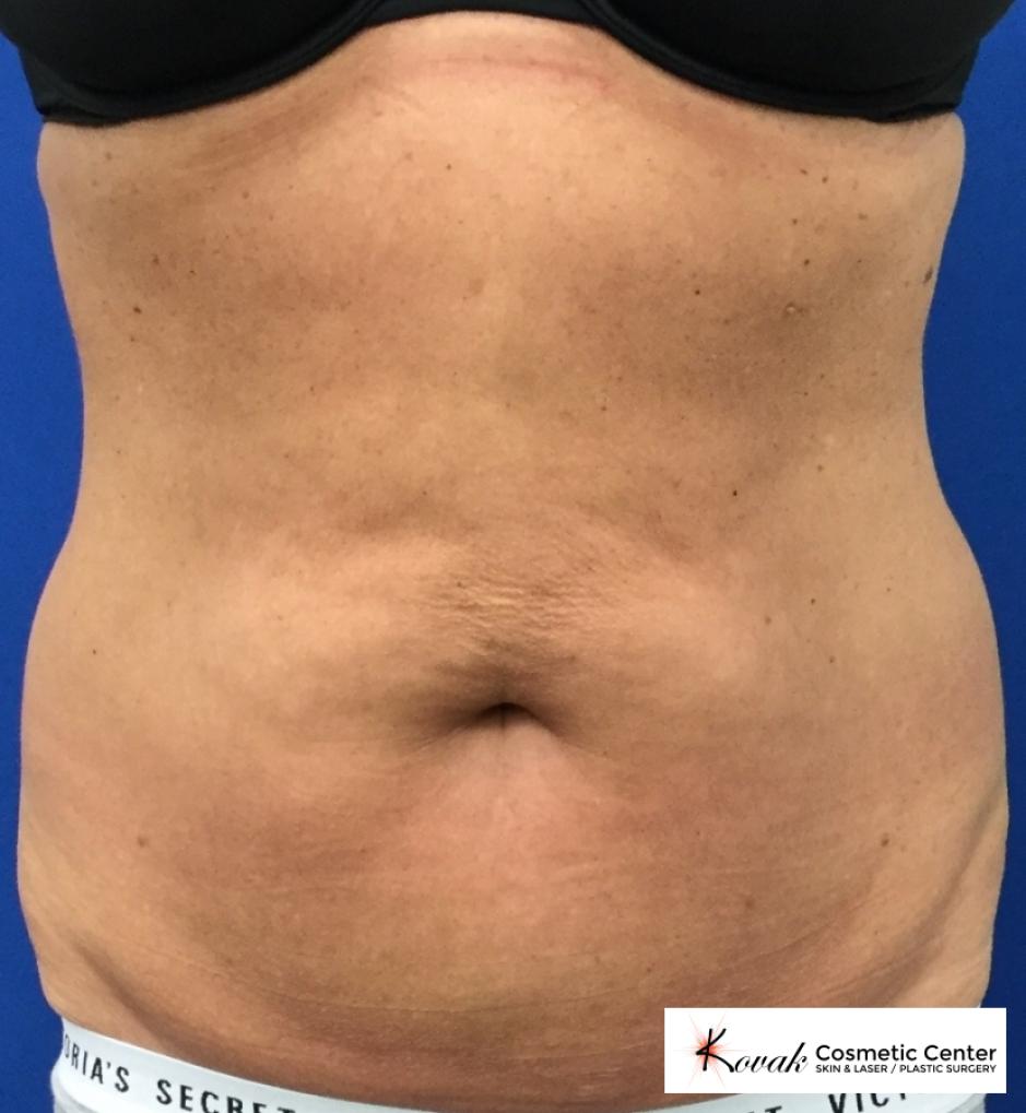 CoolSculpting®: Patient 1 - After  