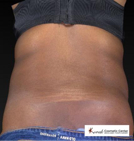 CoolSculpting®: Patient 15 - After 2