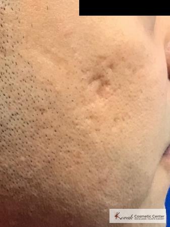 Acne Scars treated with Juvederm and Venus Viva on 35 year old male - Before and After Image 2