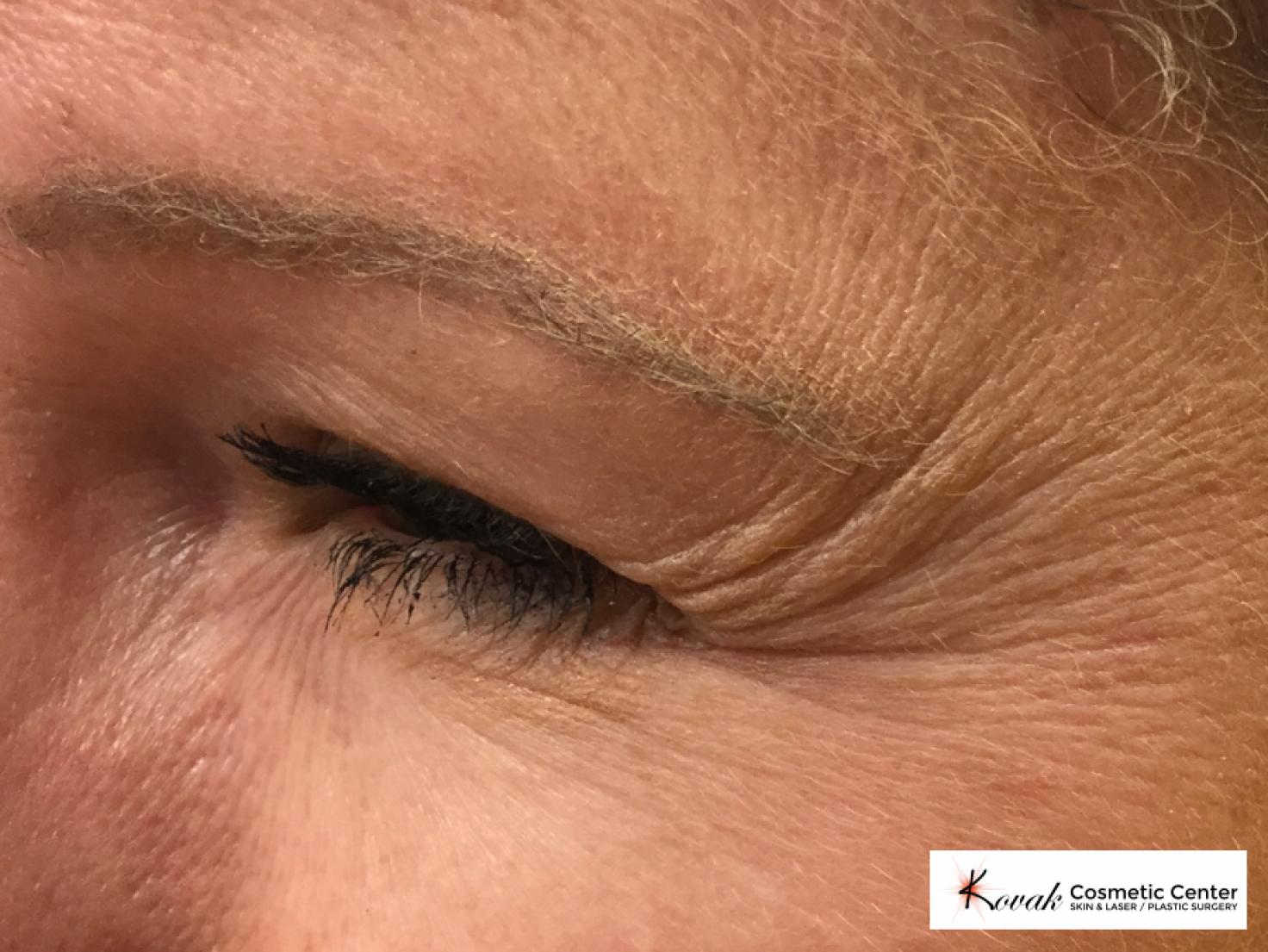 Botox for the eyes on a 40 year old woman - Before 