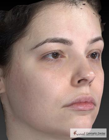 Venus Viva: Patient 4 - Before and After Image 5