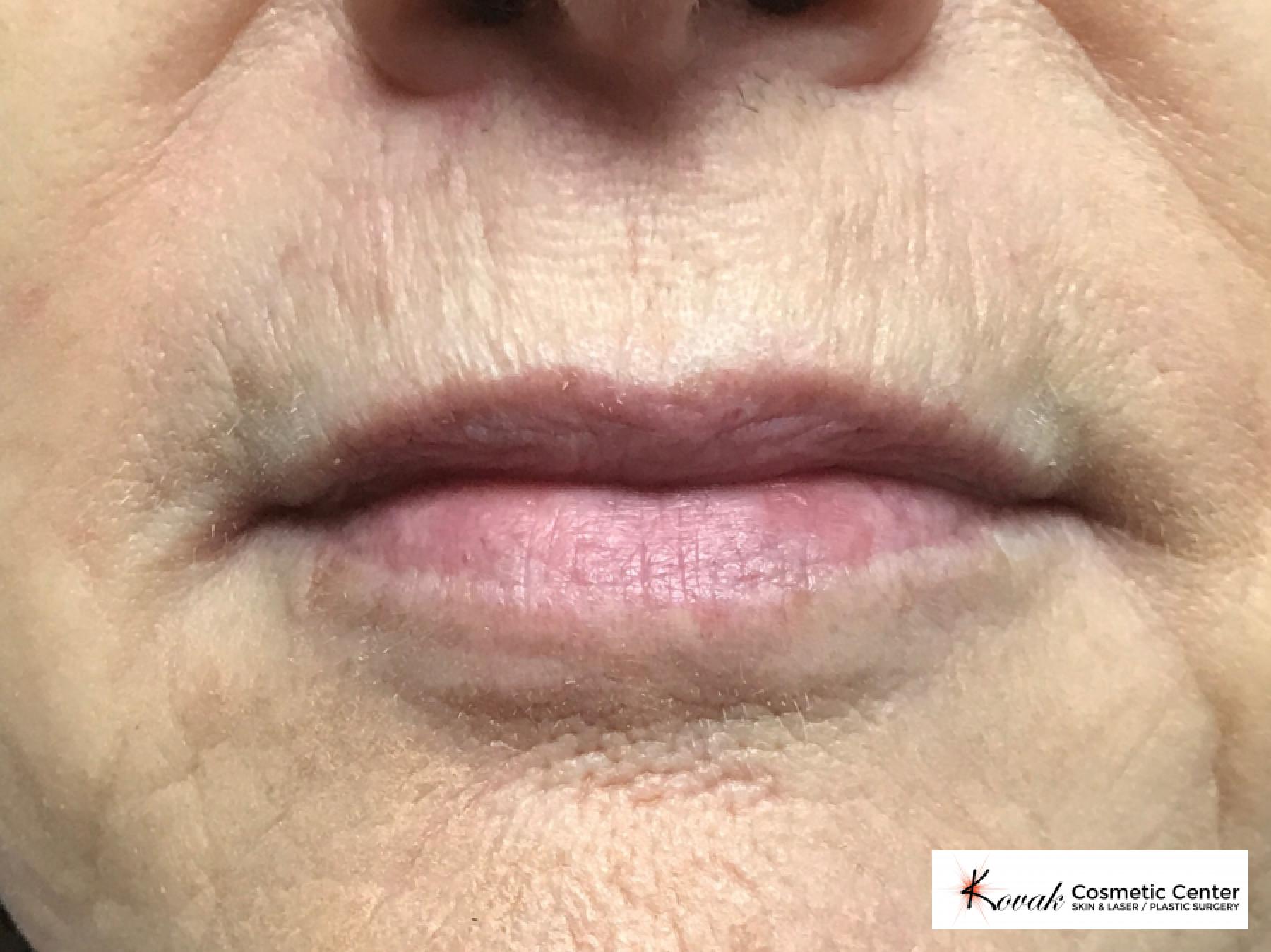 Restylane Silk for fine lines around the mouth on a 63 year old female - After 1