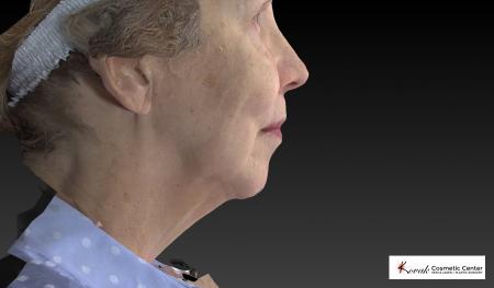 CoolSculpting®: Patient 6 - After Image 3