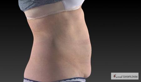 CoolSculpting®: Patient 21 - After