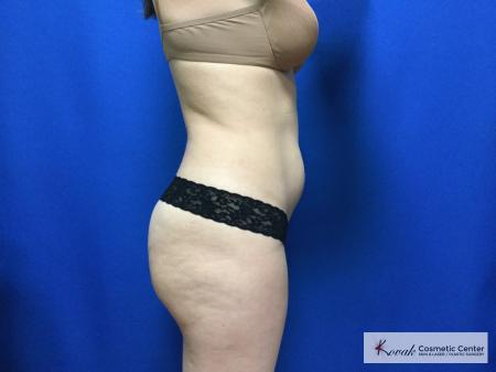 CoolSculpting®: Patient 17 - Before and After 3