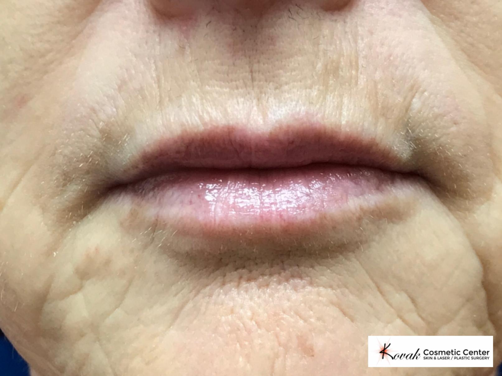 Restylane Silk for fine lines around the mouth on a 63 year old female - Before 