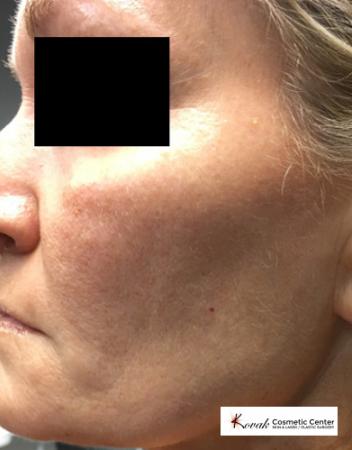 Silhouette Lift™: Patient 2 - After Image 1