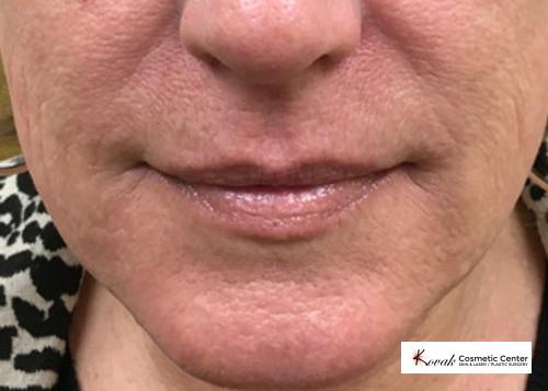 Restylane® Silk: Patient 5 - After  