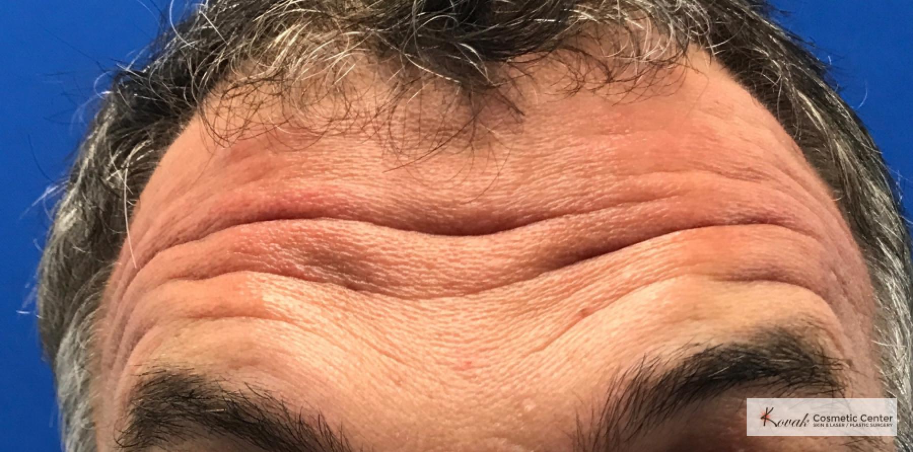 Volbella for Forehead Lines on a 52 year old male - Before 
