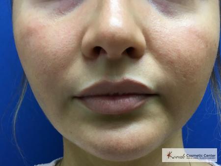Laser Liposuction of the jawline on a 25 year old female patient - After 1
