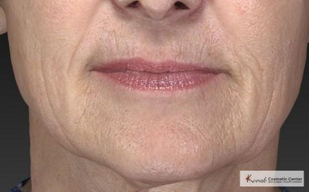 Injectables - Mouth: Patient 8 - Before Image 1