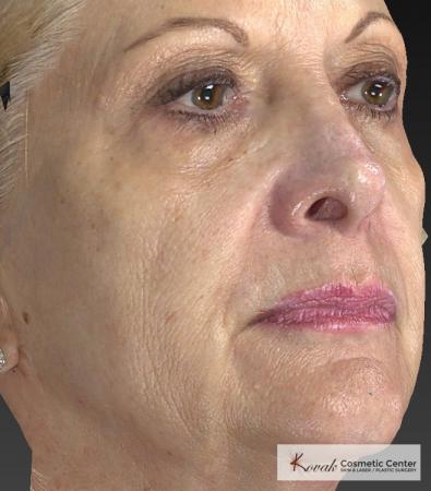 Injectables - Face: Patient 1 - Before and After 3